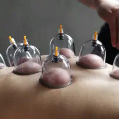 Koppning behandling på ryggen med flera koppar. En hand justerar en kopp.