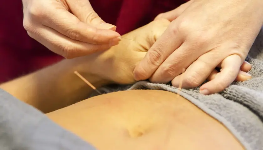 Händer utför akupunktur, en del av kinesisk medicin, på en arm.
