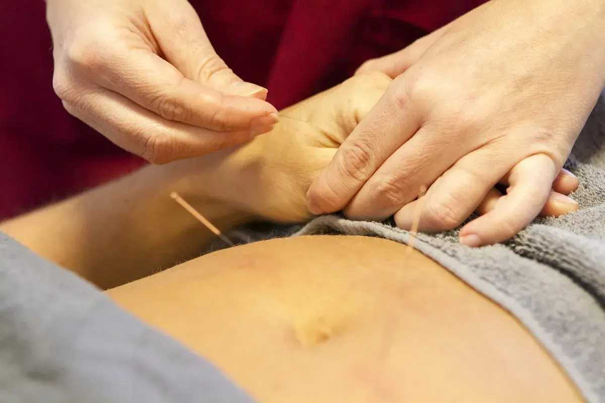 Händer utför akupunktur, en del av kinesisk medicin, på en arm.