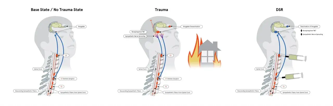 Diagrammet visar hur trauma påverkar hjärnan och nervsystemet, med en injektion som representerar trauma respons.